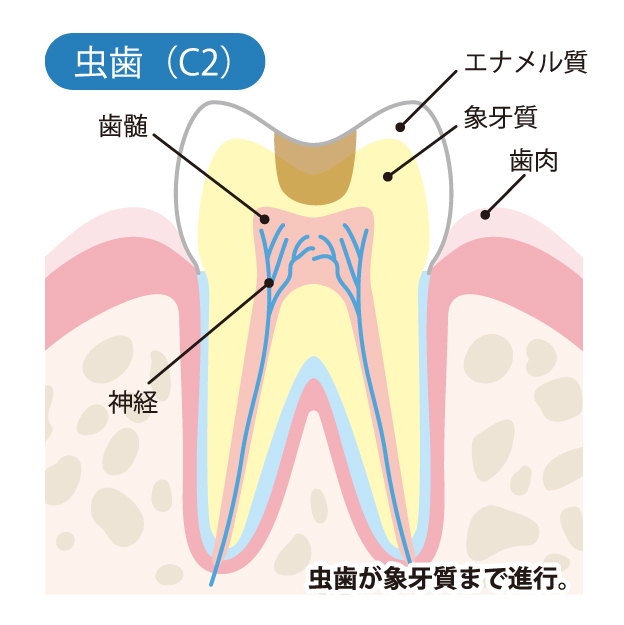 虫歯（C2）