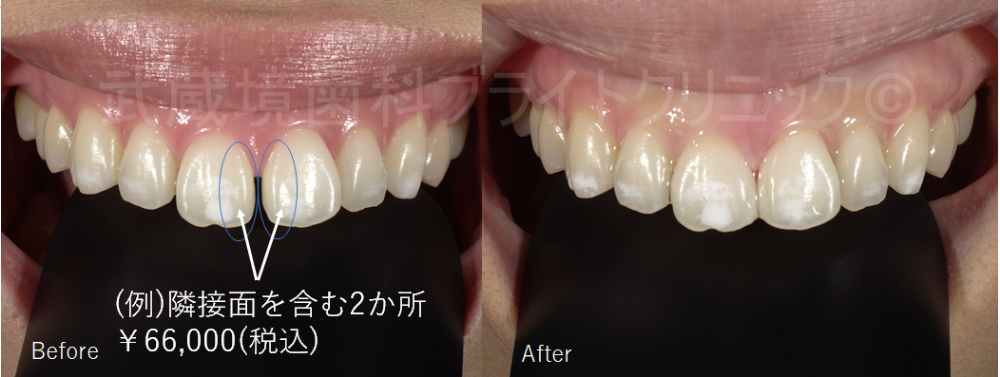 ダイレクトボンディング症例