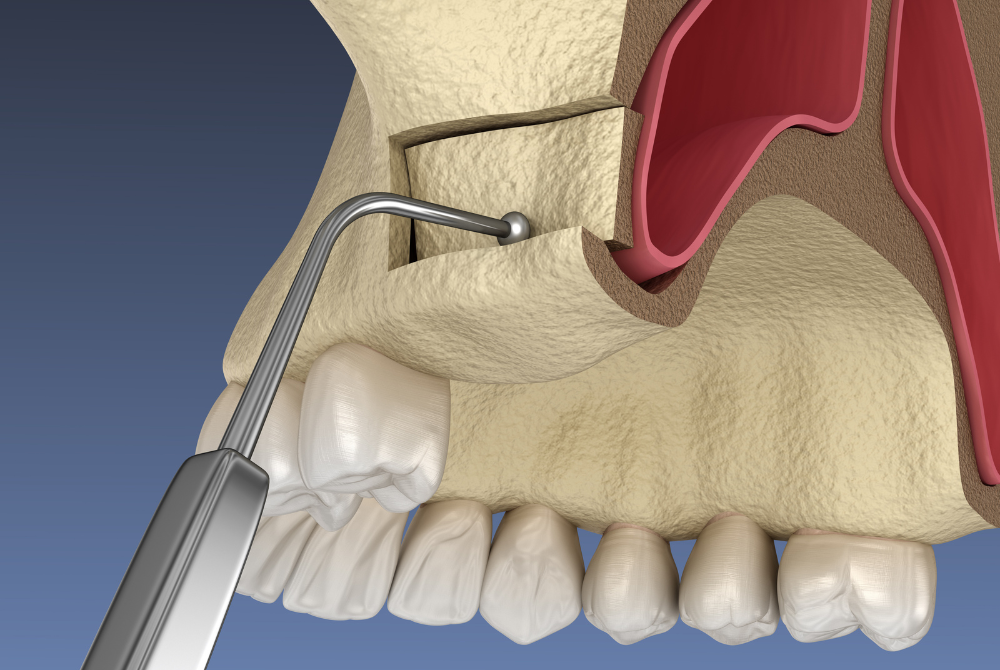 骨造成治療のイメージ
