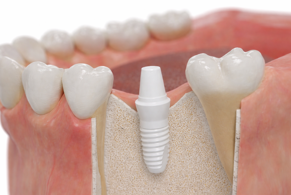 ジルコニアインプラントのイメージ
