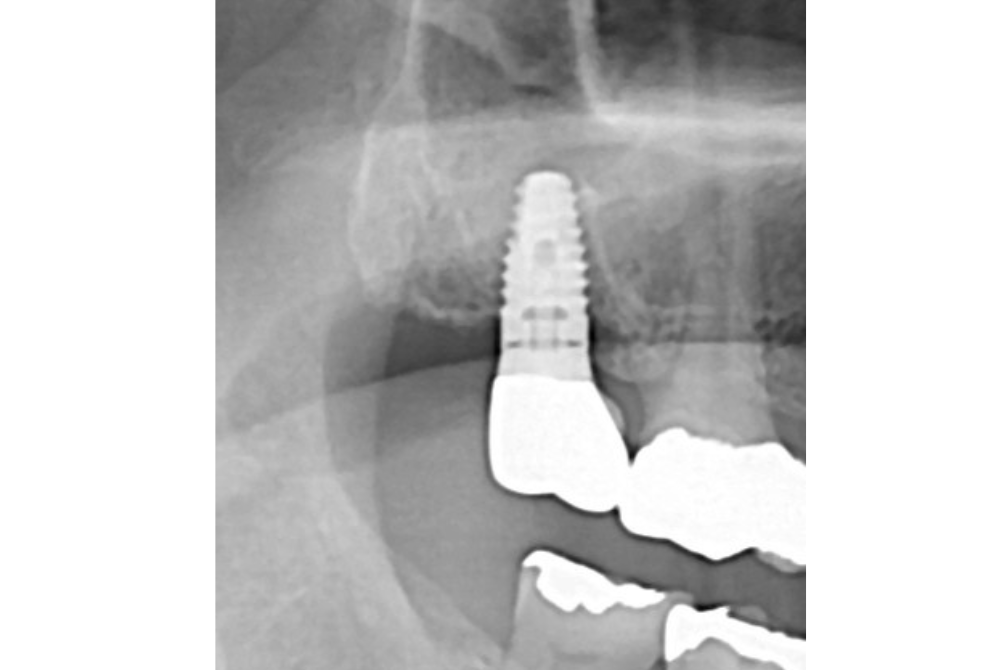 インプラント治療後（After）