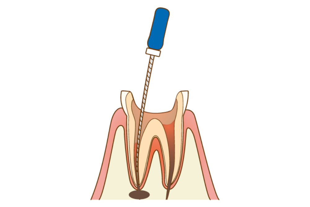 根管治療