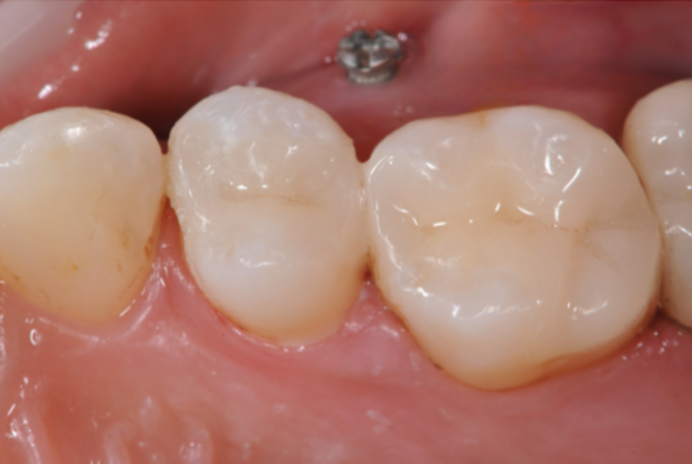 最短1日で綺麗な歯にしたい