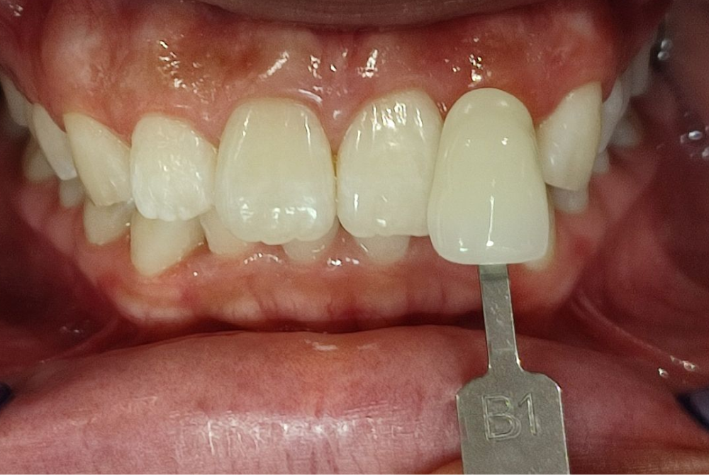 ホワイトニング後（After）