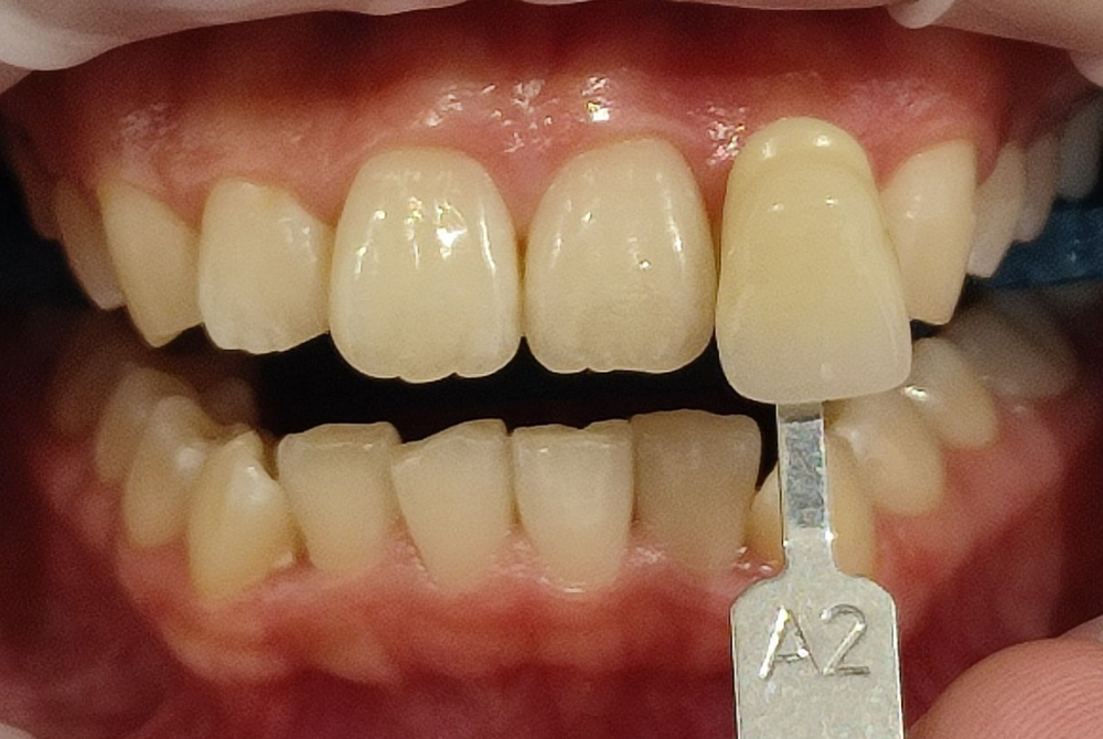 ホワイトニング前（Before）