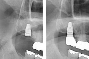 インプラント治療後