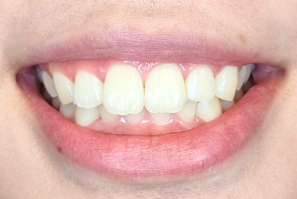 ティースジュエリー施術前（Before）