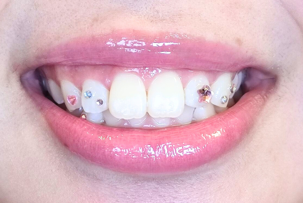 ティースジュエリー施術後（After）