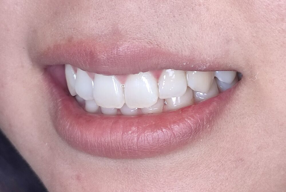 Before