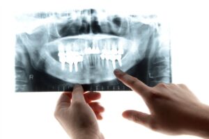 歯科用レントゲン画像で顎の骨の状態を確認する様子